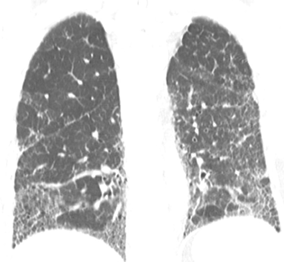 Coronal chest CT showing a usual interstitial pneumonia pattern with basal and peripheral fibrosis